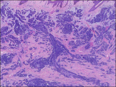 Neoplasm was in solid, tubular and cribriform aggregations that varied in size and shape. (H&E, original magnification ×40)