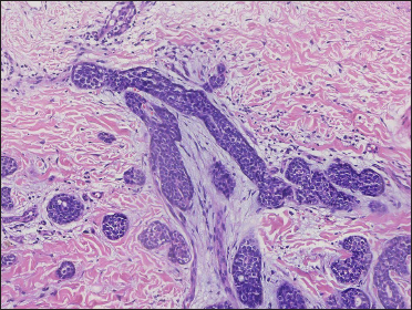 Neoplasm in tubular aggregations (H&E, original magnification ×200)