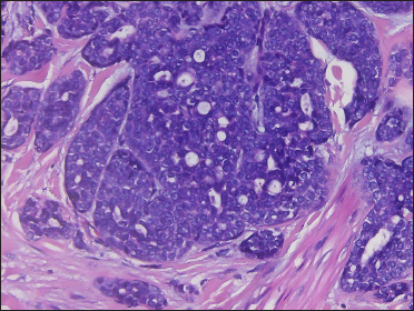 Basaloid neoplastic cells in solid and cribriform aggregations (H&E, original magnification ×400)