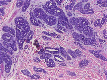 Neoplasm forming ductal and glandular structures with scant stroma (H&E, original magnification ×200)