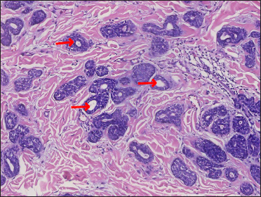 Aggregations with syringoid appearance – “syringomatous features” (red arrow) (H&E, original magnification ×200)