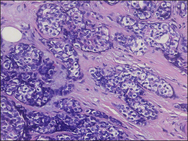 Neoplastic cells with hyperchromatic nuclei and clear cytoplasm (H&E, original magnification ×400)