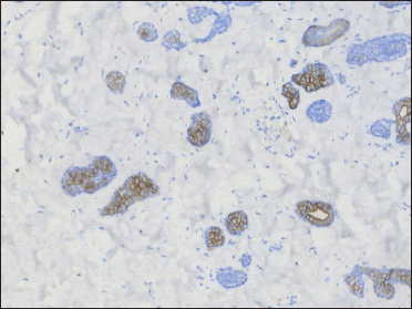 Positive CK7 on tubular aggregates (original magnification ×200)