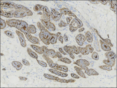 Epithelial membrane antigen highlighting the lining cells of ductal structures (original magnification ×200)