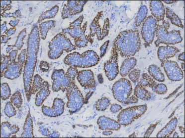 p63 positive at the periphery of the aggregates (original magnification ×200)