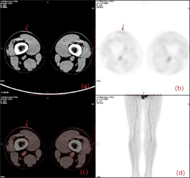 (a) CT and (b) fusion images showing a focus to be a plaque in the right lower thigh (red arrow); (c) Transaxial PET through the right lower thigh showing a distinct hypermetabolic focus (red arrow); (d) An anterior projection PET image showing an indeterminate focus in the lower thigh skin