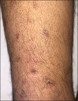 Shiny erythematous macules on right thigh