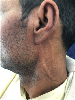 Thickened posterior auricular nerve