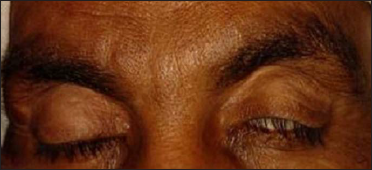 Madarosis in both eyes and lagophthalmos in the left eye