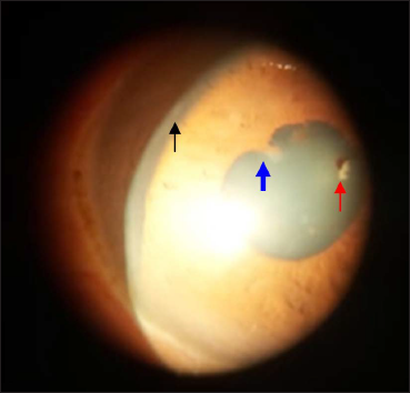 Right eye showing superficial punctate keratitis (black arrow), posterior synechiae (blue arrow) and pigments on anterior lens capsule (red arrow)