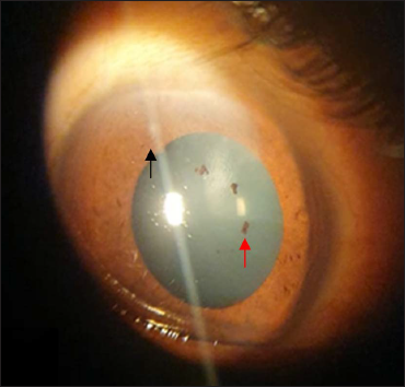 Left eye showing superficial punctate keratitis (black arrow) and pigments on anterior lens capsule (red arrow)