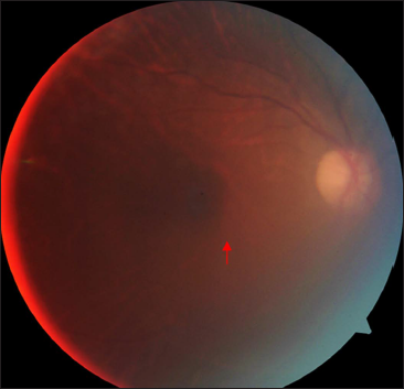 Colour fundus photograph of the right eye showing shallow subretinal fluid at macula (red arrow). Fundus view is hazy due to presence of posterior synechiae