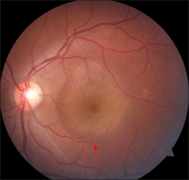 Colour fundus photograph of the left eye showing subretinal fluid at macula (red arrow)