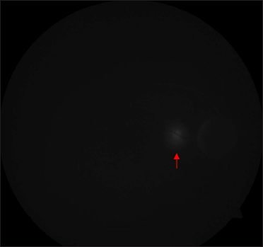 Fundus fluorescein angiography of the right eye showing hyperfluorescence nasal to fovea (red arrow)