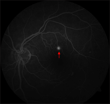 Fundus fluorescein angiography of the left eye showing ink blot leak superior to fovea (red arrow)