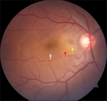 Fundus of the right eye showing shallow subretinal fluid (white arrow) with fibrin (red arrow) and pigment epithelial detachment (yellow arrow) nasal to fovea on follow-up