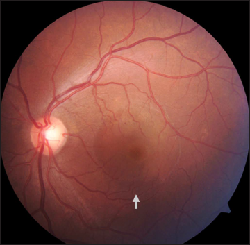 Fundus of the left eye showing decrease in subretinal fluid at macula (white arrow) on follow-up