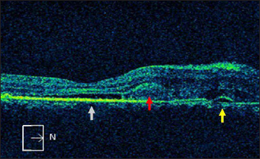 Spectral domain optical coherence tomography of the right eye in the corresponding area showing shallow subretinal fluid (white arrow) with fibrin (red arrow) and pigment epithelial detachment (yellow arrow) nasal to fovea