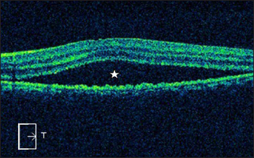 Spectral domain optical coherence tomography of the left eye in the corresponding area showing subretinal fluid at macula (star)