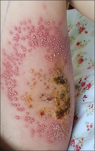 Crusted plaque surrounded by pustules on erythematous base on medial aspect of left thigh