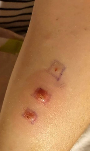 Pathergy test positivity showing erythematous papules and pustules