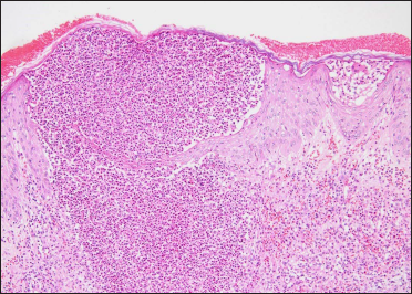 Subcorneal intraepidermal spongiotic pustule, expanding into dermis, erythrocyte extravasation and oedema in the adjacent dermis, infiltrate consisting of mainly neutrophils and eosinophils (Hematoxylin and eosin, ×100).