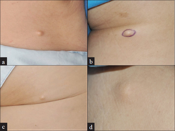 (a) A skin colored nodule on the back of case 1; (b) A skin colored nodule on the right thigh of case 2; (c) A skin colored nodule on the right thigh of case 3; (d) A skin colored nodule on the left thigh of case 4