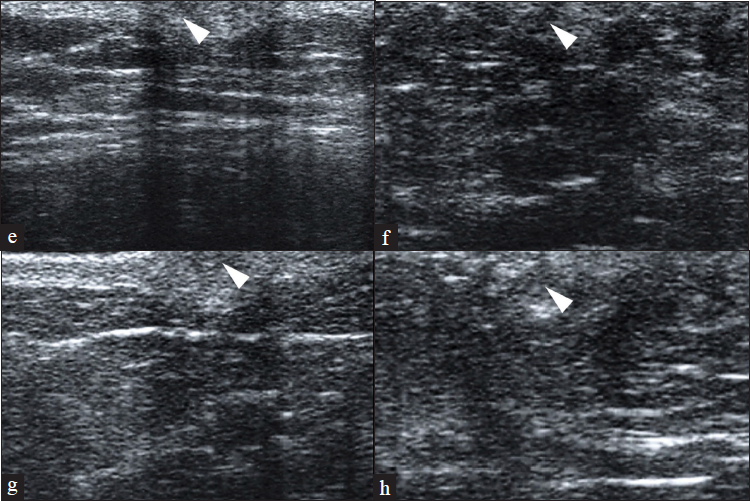 Ultrasonography of case 1–3 showed a heterogeneous isoechoic mass with the focal hypoechoic area (white arrowheads) and posterior acoustic shadow [Ultrasound frequency: 11.4 MHz]. Ultrasonography of case 4 showed a hyperechoic lesion with the central hypoechoic area (white arrowhead) and posterior acoustic shadow [Ultrasound frequency: 11.4 MHz]