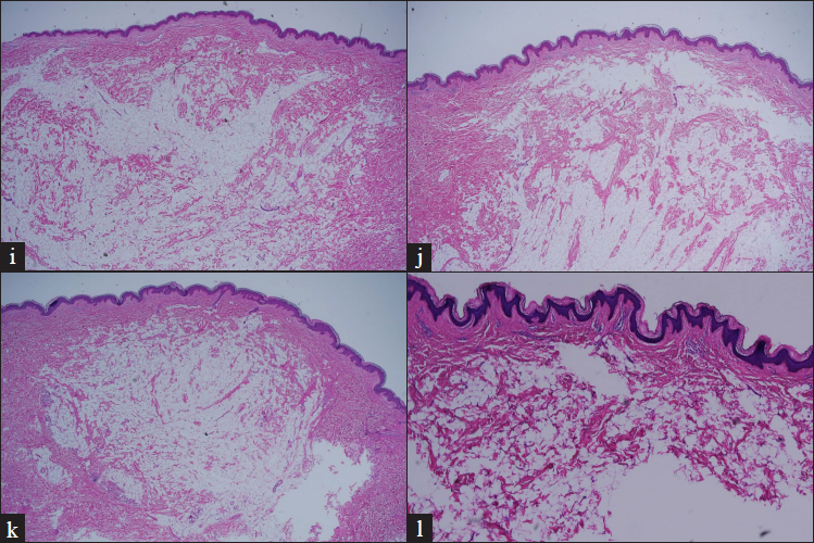 The histopathology of case 1–3 revealed characteristic proliferation of ectopic mature adipocytes with thickening of collagen bundles present in the dermis [H and E ×20]. The histopathology of case 4 revealed closely packed adipocytes intermingled with collagen bundles [H and E, ×40]