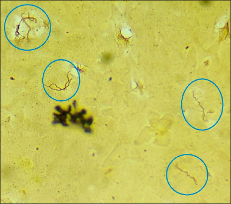 Smear from ulcer base showing multiple slender spiral spirochaete (in blue circles) (Masson-Fontana silver stain 1000× magnification)