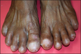 Acquired anonychia of toes. Note: intertrigo affecting web spaces of the right foot and 4th web space of left foot. Also, healing ulcers over the nail bed area of the right 1st and 2nd toes, and left 4th toe is appreciable