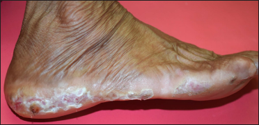 Macerated skin along the Wallace line with self-inflicted ulcers of different shapes and depths