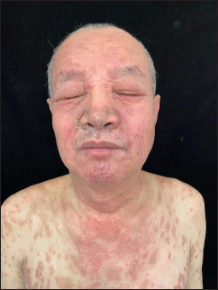 Erythema, oedema, erythematous papules and scaling involving the face