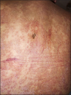 A close-up view of the lesions on the back showing follicular papules and plaques with scaling