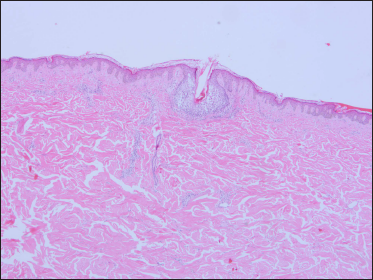 Mild hyperkeratosis of the epidermis, focal spongiosis, obvious oedema of the folliculus pili and sebaceous gland epithelium (H and E, × 40)