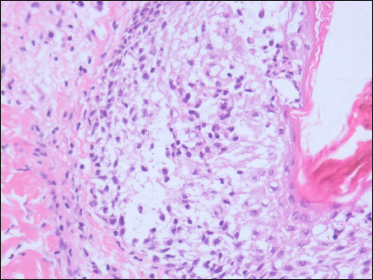 Lymphocytes and histiocytes infiltrating within and around the hair follicles and sebaceous glands (H and E, × 400)