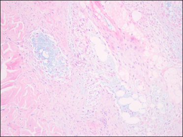 Mucin deposition in the hair follicles (Alcian blue, × 200)