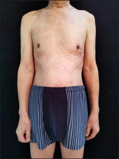 Post-inflammatory pigmentation on the trunk after treatment