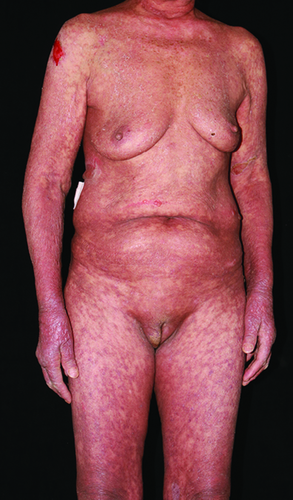 Erythema and brown pigmentation over the torso, arms and legs