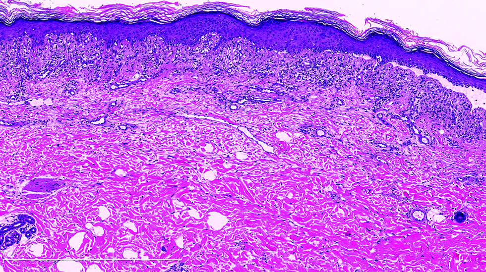 Under low power view, lichenoid tissue reaction, subepidermal blister and a mixed dermal superficial infiltration was noted