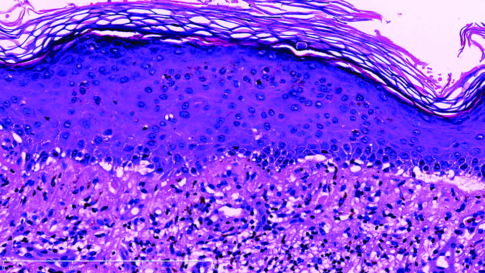 Under high power view, liquefaction degeneration in basal membrane with a predominant lymphoid infiltration was obeserved in the epidermal-dermal junction and superficial dermis