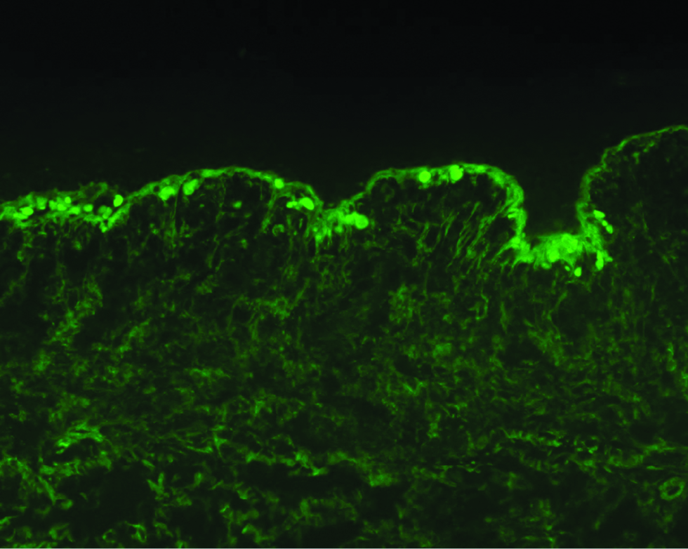 Direct immunofluorescence analysis of lesional skin showing strong granular deposition of IgG antibodies at the dermal-epidermal junction