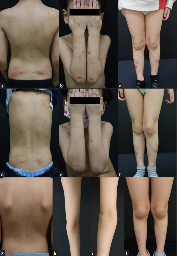 Patient 2 (atopic dermatitis with prurigo nodularis phenotype) at (a–c) baseline, (d–f) four weeks and (g–j) six months after their first injection of dupilumab