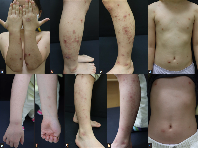 Patient 3 (atopic dermatitis with prurigo nodularis phenotype) at (a–d) baseline and (e–i) four weeks after their first injection of dupilumab