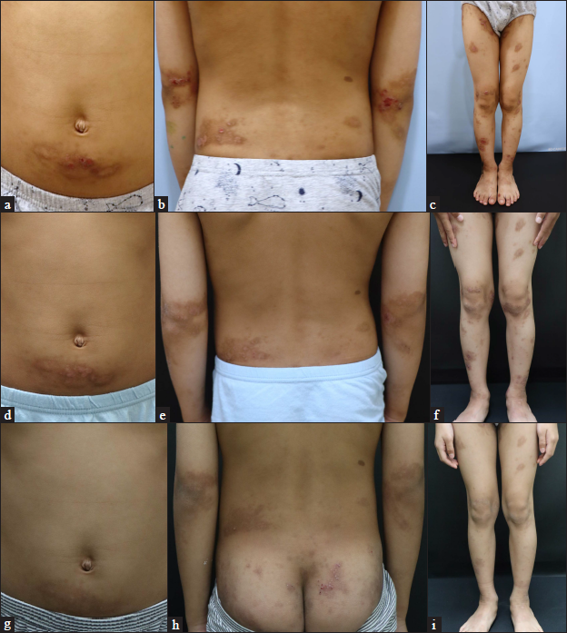 Patient 4 (atopic dermatitis with prurigo nodularis phenotype) at (a–c) baseline, (d–f) four weeks and (g–i) six months after their first injection of dupilumab