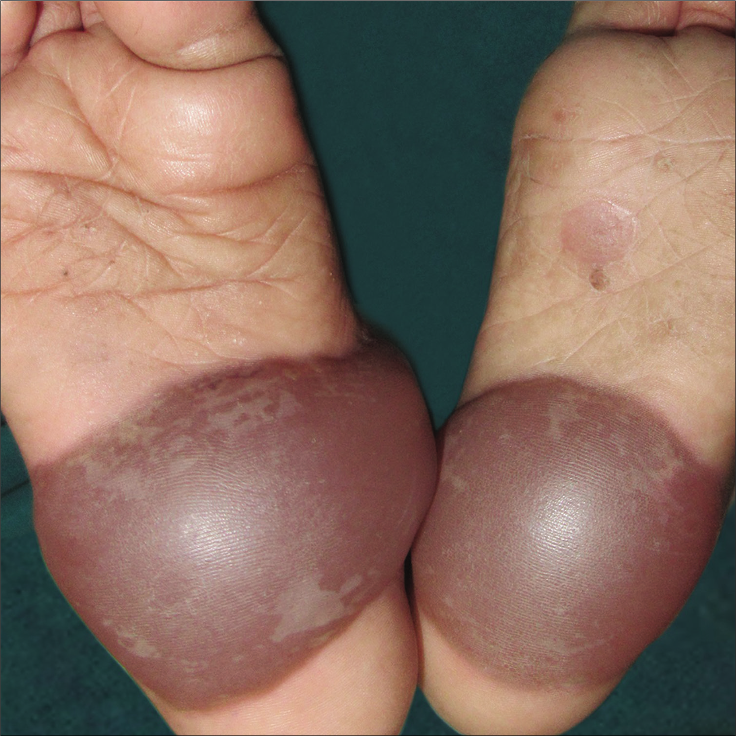 Hemorrhagic bullae on soles