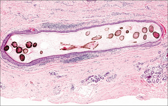 A cyst located in the mid-dermis with wall demonstrating epidermoid keratinization (H and E, ×100)