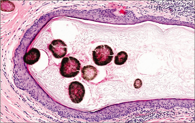 Cyst cavity shows cross-sections of thick and deeply pigmented hair shafts composed of an eosinophilic medulla and melanin granules (H and E, ×200)