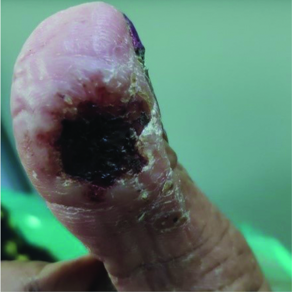 Necrotic ulcer on right thumb