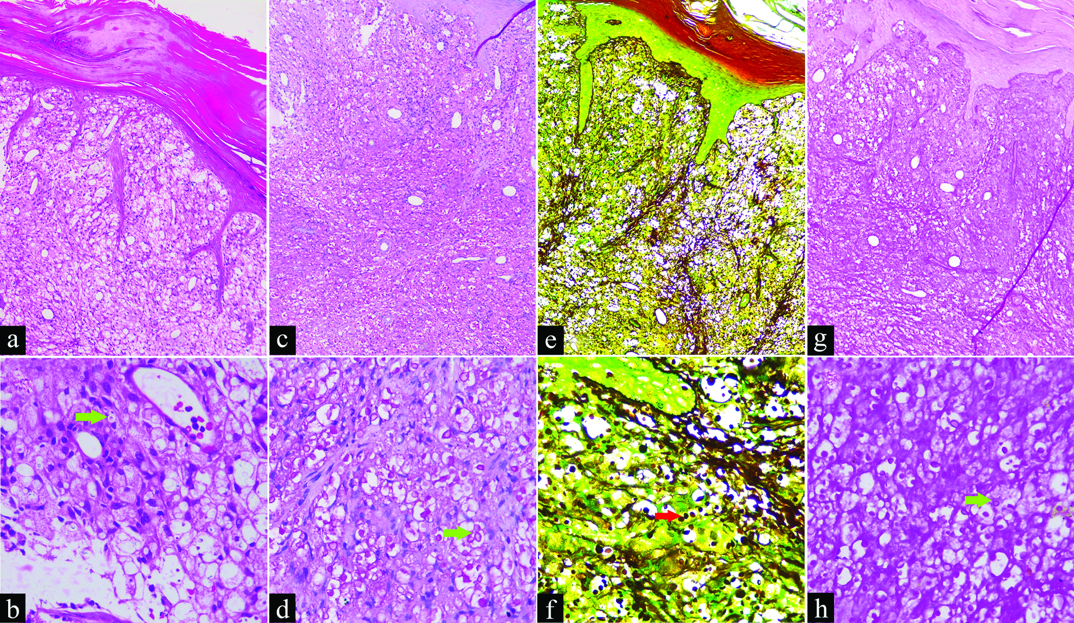 (a) Edge of ulcer showing hyperkeratosis, parakeratosis, dermal edema with mixed inflammatory infiltrates and many spores within and outside histiocytes (H&E, × 100); (b) High power view (green arrow) showing yeast forms–extracellular and within the histiocytes (H&E, × 400); (c and d) Red spores (Mucicarmine stain, × 100 & × 400); (e and f) (red arrow) Black spores (Gomori methenamine silver stain, × 100 & × 400); (g and h) (green arrow) Purple staining of cryptococcus and unstained capsule (Periodic acid-Schiff stain, × 100 & × 400)